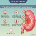 راه‌های کاهش عوارض فلج معده/ اینفوگرافیک