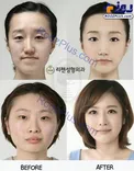 معجزه عمل زیبایی در زنان کره جنوبی+عکس