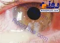 آنچه ترشحات چشم درباره سلامتی چشمتان می گوید
