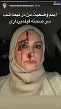 خانم بازیگر با صورت زخمی و خونی+عکس