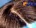 فریب تبلیغات رنگارنگ را نخورید/با شامپو ،شوره شدید سر درمان نمیشود