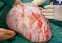 خروج توده 7 کیلویی از شکم یک زن +عکس
