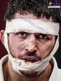 سوژه شدن صورت زخمی جودوکار المپیک+عکس