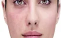هشدار/ لکه های قرمز پوست، نشانه این بیماری های خطرناک است!