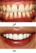 تب داغ لمینیت دندان/ مفید یا مضر؟