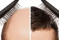 دلیل ریزش مو و تار موها در زنان چیست؟ +راه حل درمانی