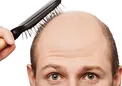 با طب سنتی ریزش مو را متوقف کنید