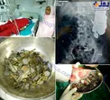خروج 263 میخ و سکه از معده مرد 35 ساله +تصاویر