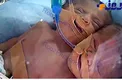 تولد نوزاد دوسر ودوقلب در غزه +عکس