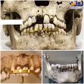 دندان مصنوعى و لمينت و در مصر باستان+عکس