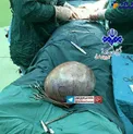 عکس/ خارج کردن توده ۸ کیلویی از شکم زن آذری