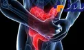 همه چیز درباره کولیت روده