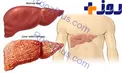 درباره سیروز کبدی بیشتر بدانید