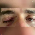 عکس/ میزان شدت جراحت چشم انصاری فرد