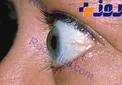 علت اینکه چشم‌ها از حدقه بیرون می‌زند چیست؟