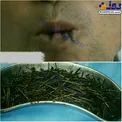 خروج 649 میخ 5سانتی از شکم مرد 48 ساله+عکس