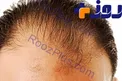 معجزه‌هایی برای رفع طاسی +اسامی