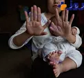 نوزادی عجیب 31 انگشتی چینی زیر تیغ جراحی می رود+عکس