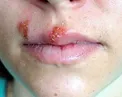 ویروسی دردناک که درمان قطعی ندارد + بهترین زمان استفاده از دارو‌های ضد تبخال