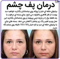 درمان پف چشم + عکس