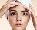 ماسک‌های طبیعی برای درمان جوش و آکنه