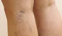 واریس پا به سراغ چه کسانی می‌رود؟ + راهکار درمان