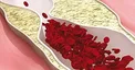 چگونه اختلالات چربی خون را کنترل کنیم؟