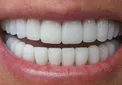 فرمول‌های معجزه آسای طب سنتی برای سفید کردن دندان‌ها