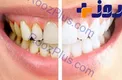 جرم دندان را با روش های طبیعی برطرف کنید