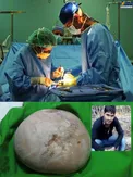 سنگ کلیه ای به اندازه ۲ توپ تنیس! + عکس