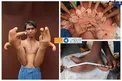 رشد عجیب انگشتان دست یک پسر هندی +عکس