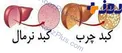 ابتلای 40 درصد ایرانیان به کبد چرب