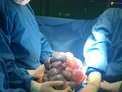 عکس/ خارج کردن توده ۹ کیلویی از بدن یک بیمار ۶۰ ساله