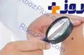 با خال های خطرناک آشنا شوید