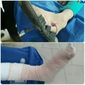 تصویری دلخراش از وجود چاقو در پای پسر ۱۱ ساله /+16