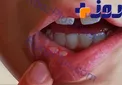 علت بروزآفت دهانی چیست وچه راهکارهایی برای مقابله باآن وجود دارد؟